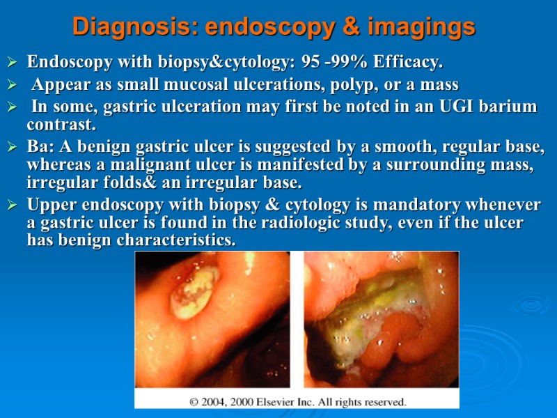 Diagnosis: endoscopy & imagings Endoscopy with biopsy&cytology: 95 -99% Efficacy.  Appear as small